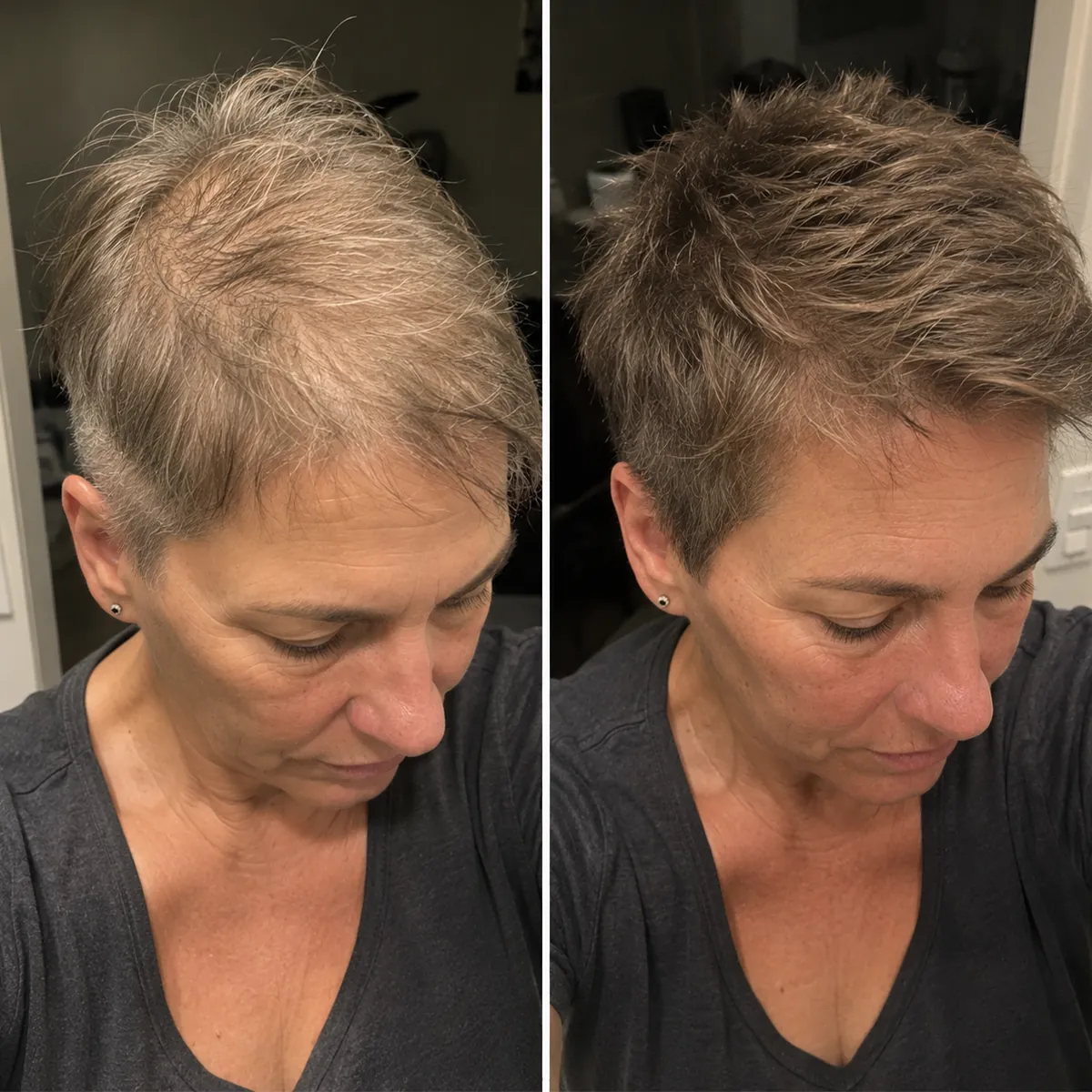 Vera cliente Folixir, 40–50 anni, capelli corti: densità sulla sommità del capo prima e dopo un uso costante