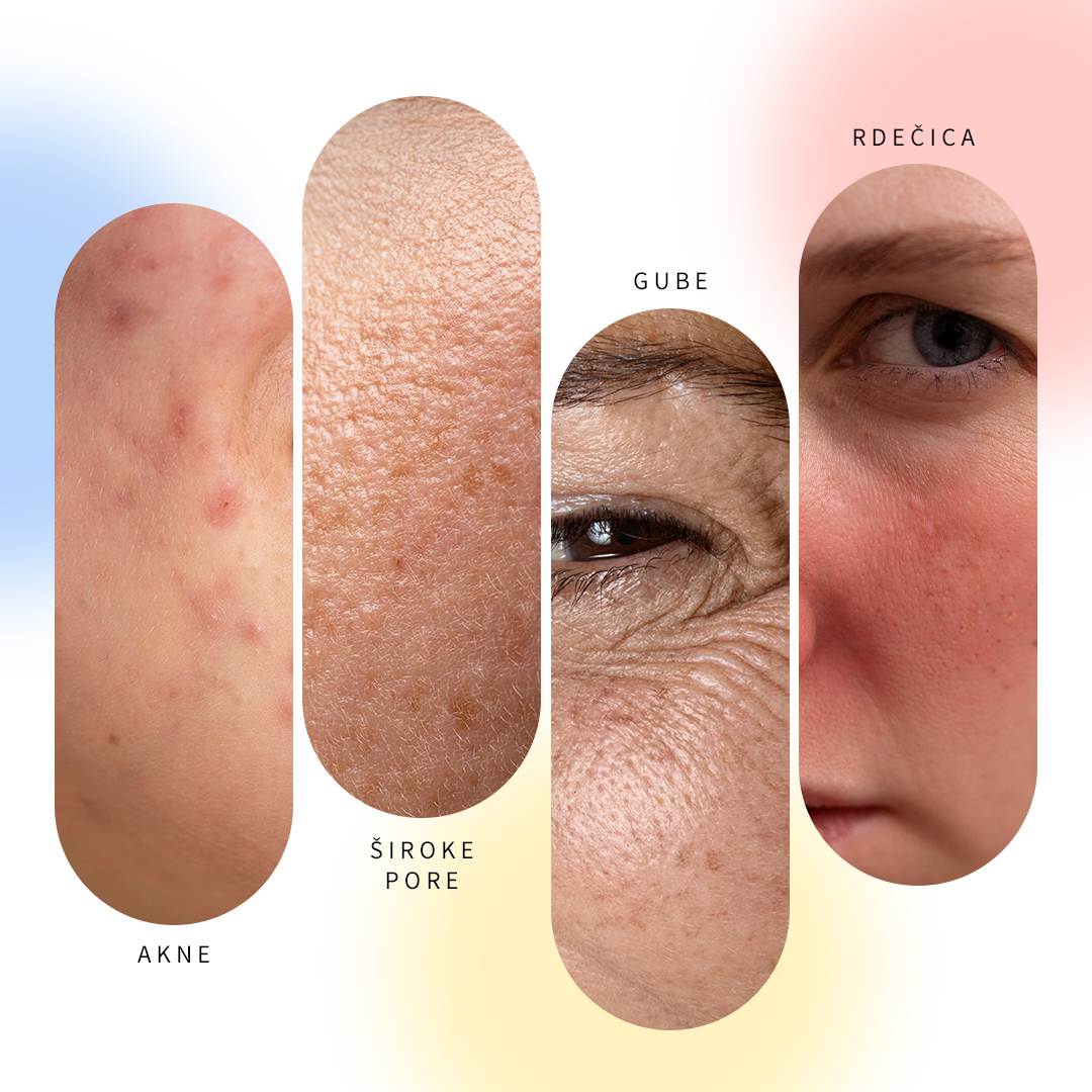 Problemi della pelle: acne, pori, rughe, rossore